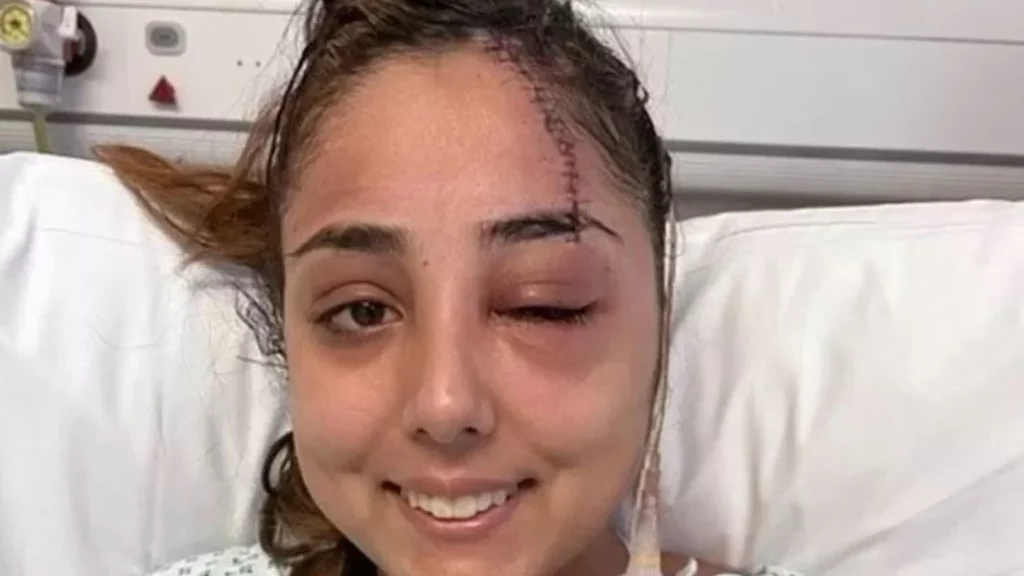 Conductoras: El riesgo que supone conducir con una pinza en el pelo 2 Motor16 Así quedó Jeena Panesar, la conductora que fue afectada por una pinza de cabello